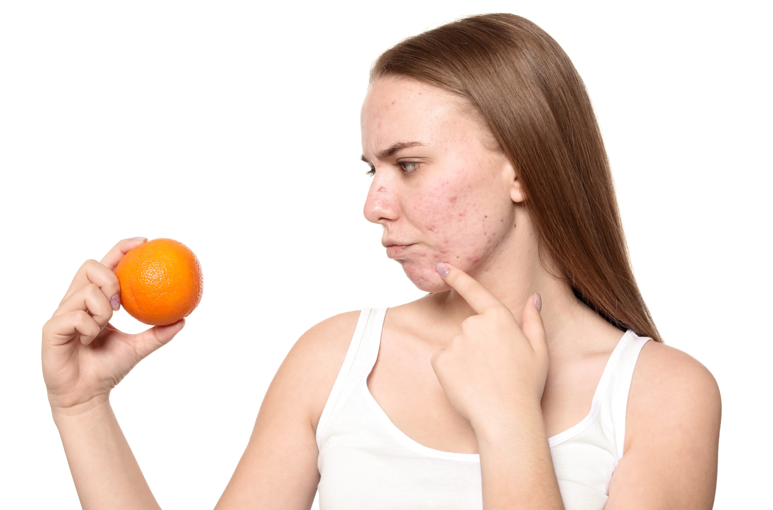 Young woman with acne problem holding orange on white background.